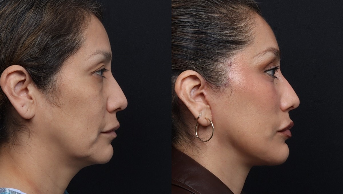 Facelift Before & After
