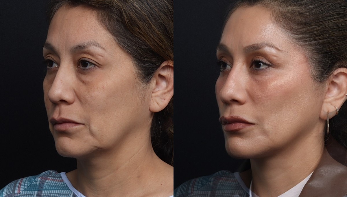 Facelift Before & After