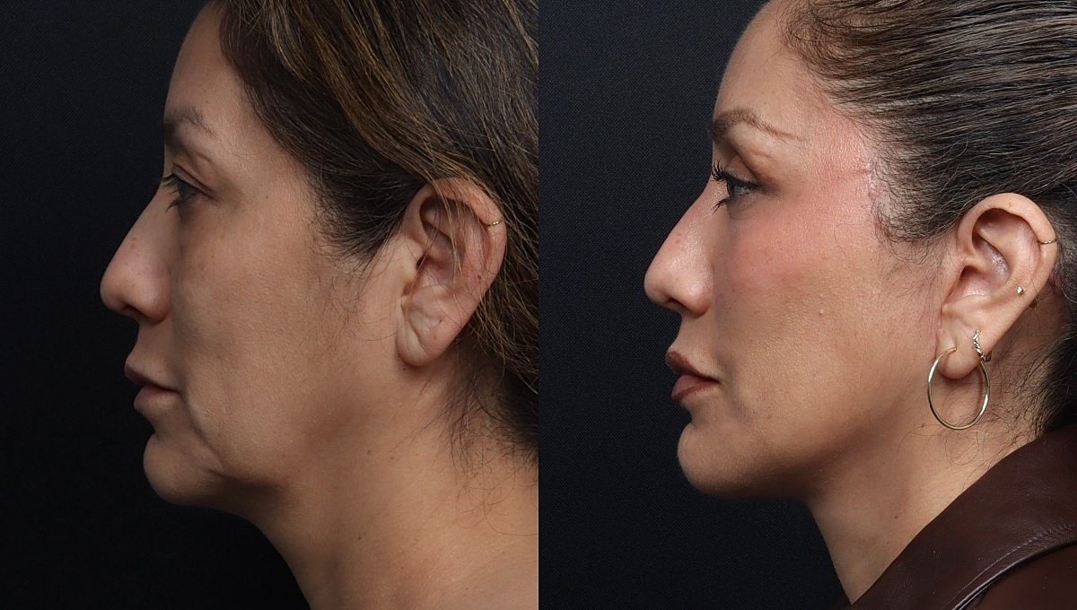 Facelift Before & After
