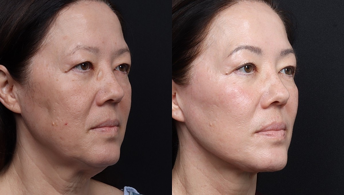 Facelift Before & After