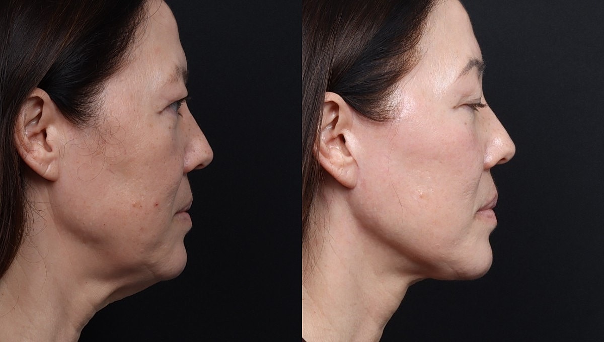 Facelift Before & After