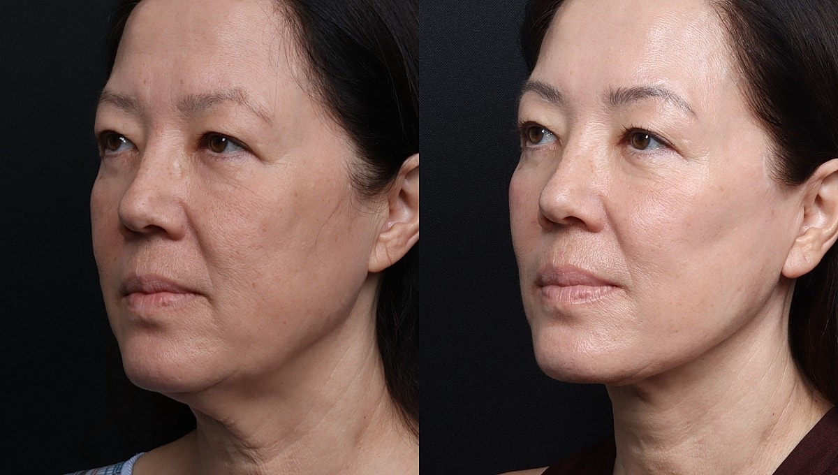Facelift Before & After