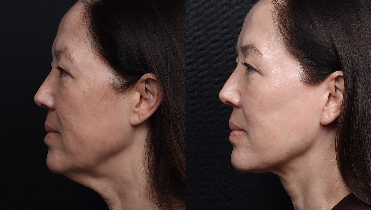Facelift Before & After