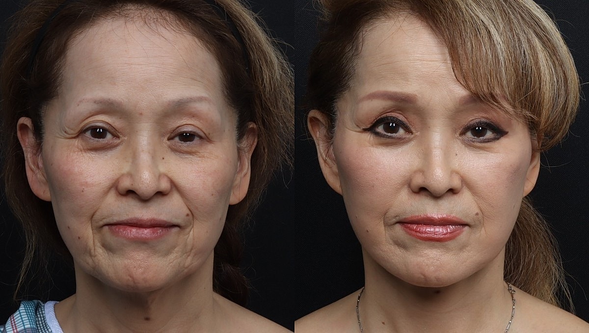 Facelift Before & After