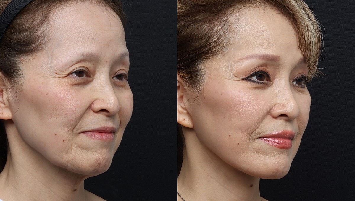 Facelift Before & After