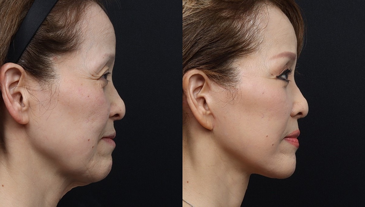 Facelift Before & After