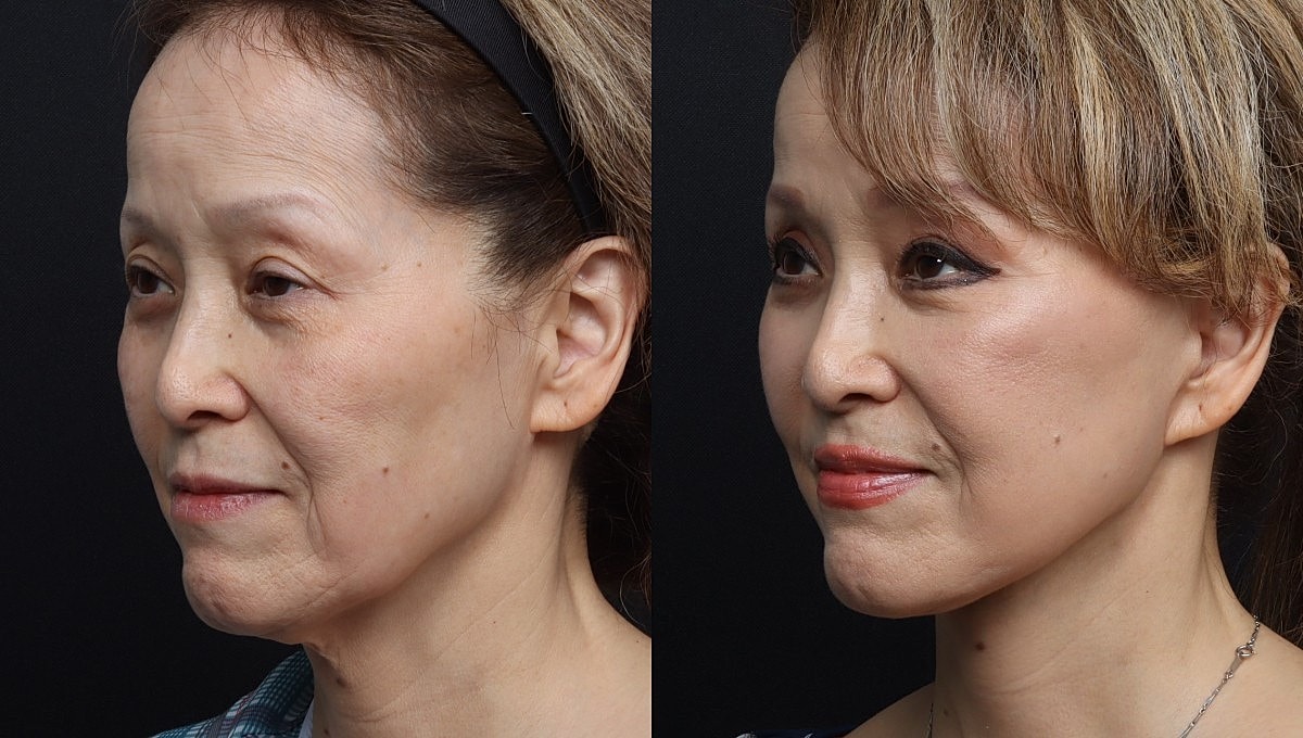 Facelift Before & After