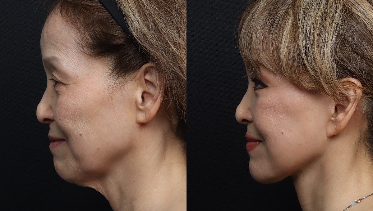 Facelift Before & After