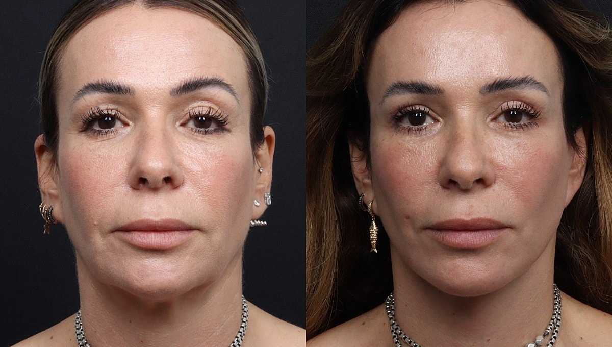 Facelift Before & After