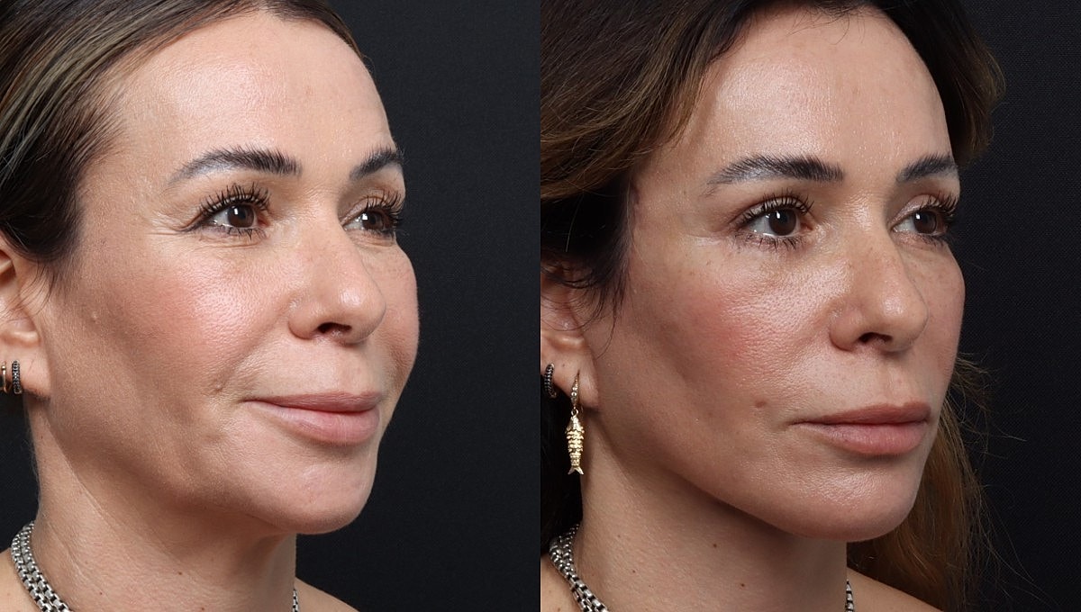 Facelift Before & After