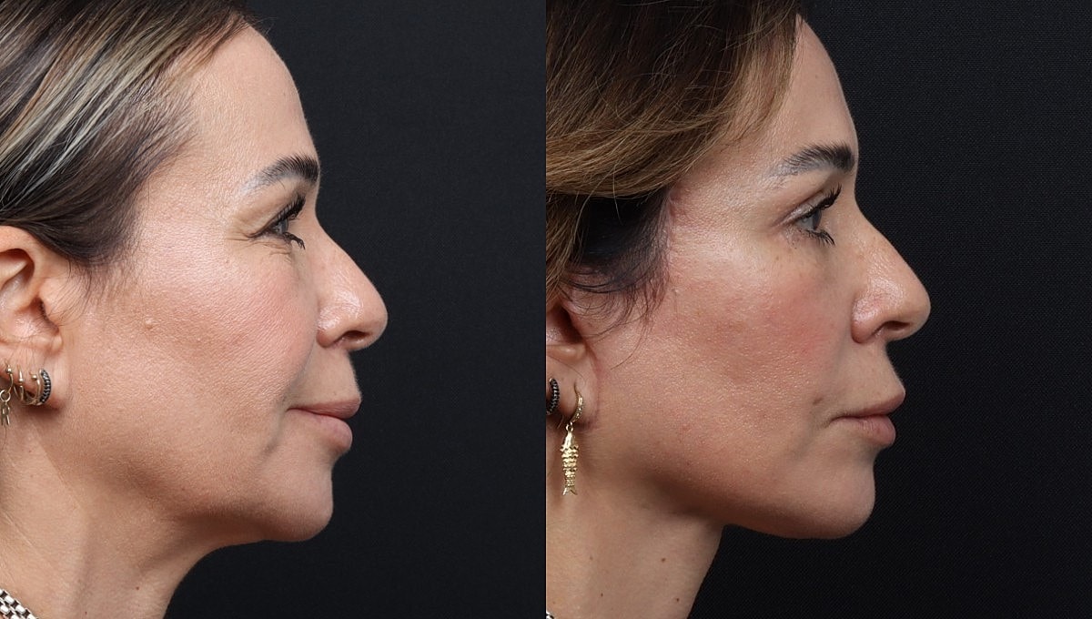 Facelift Before & After