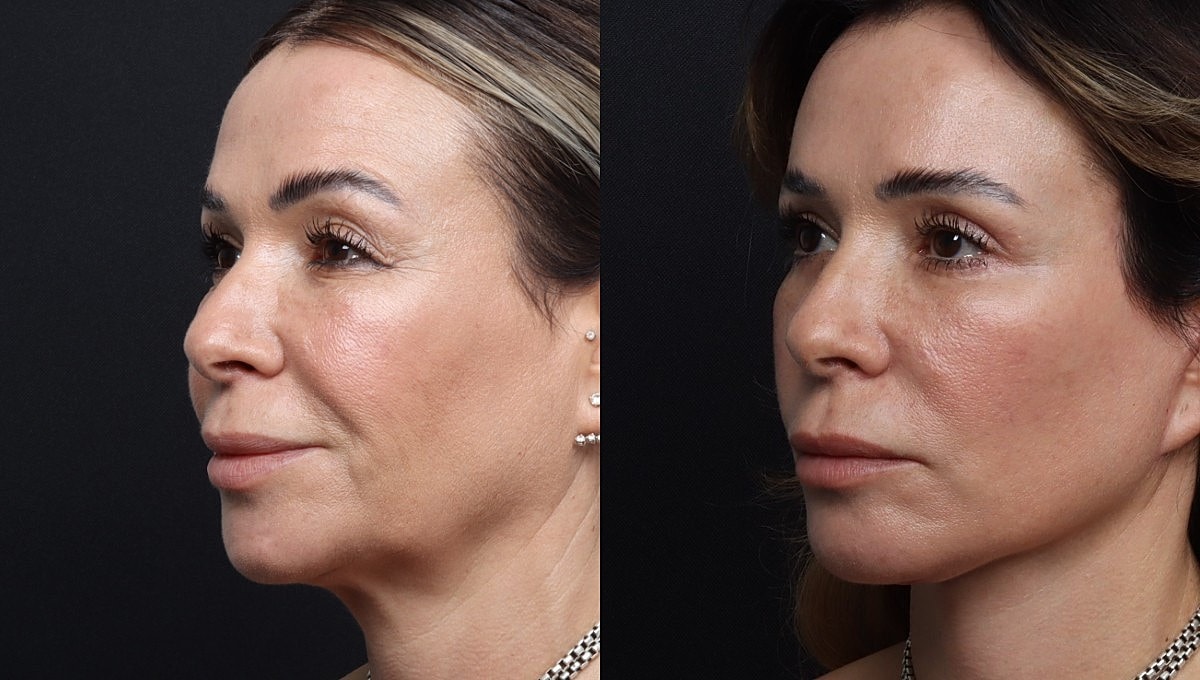 Facelift Before & After