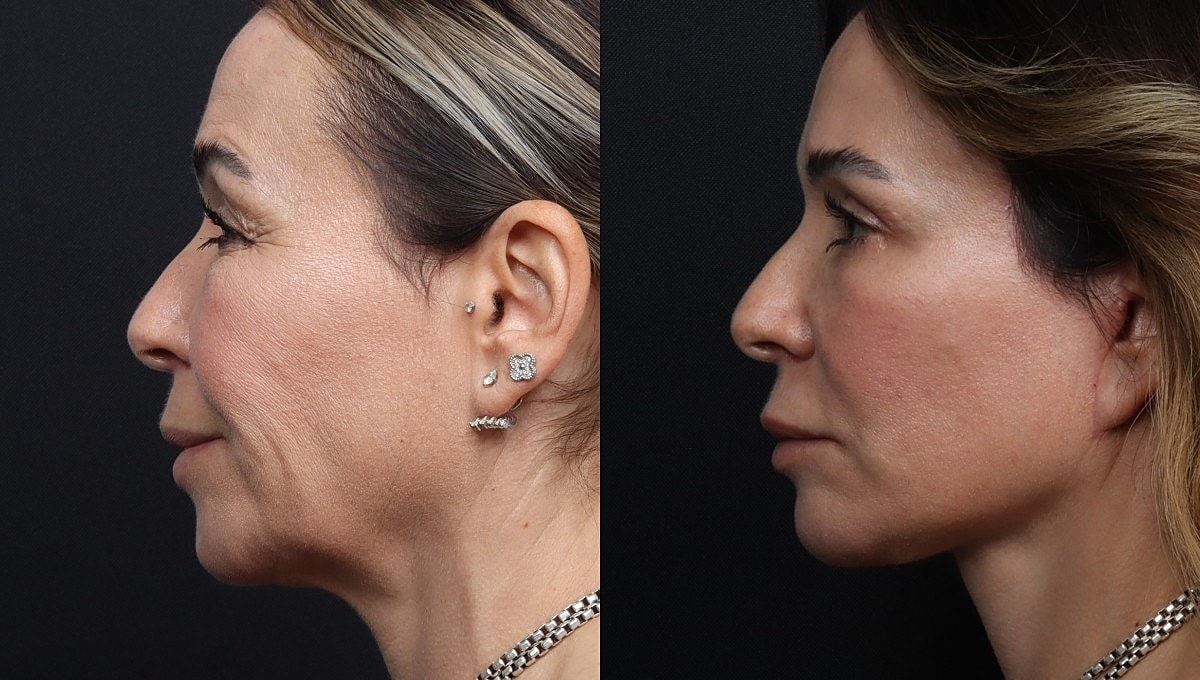 Facelift Before & After