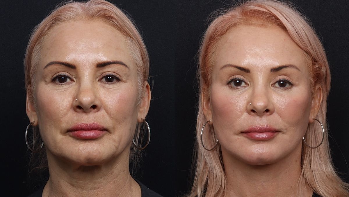 Before and after facial aesthetic treatment comparison.
