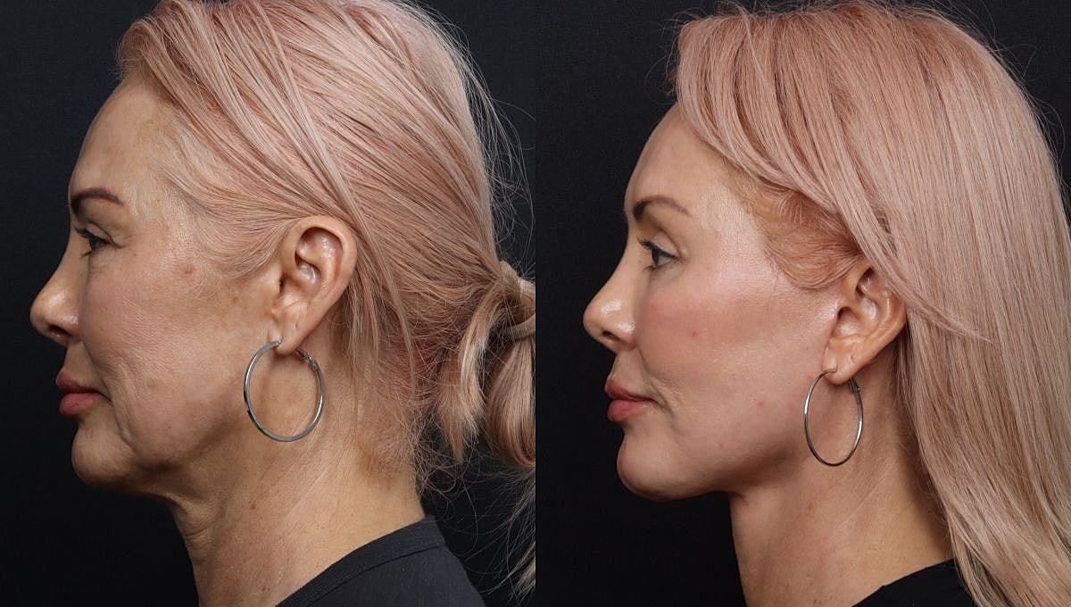 Before and after facial rejuvenation comparison image.