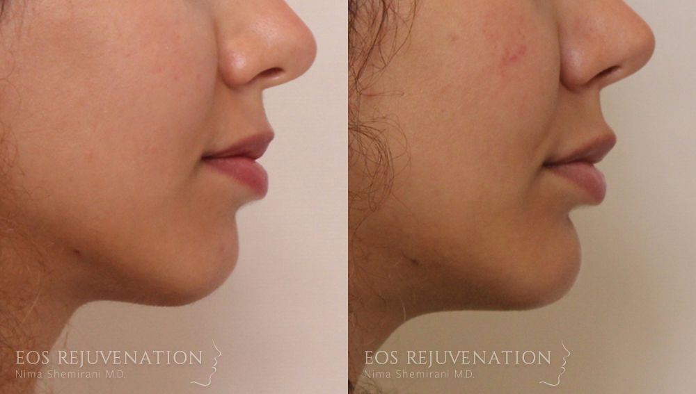 Chin Augmentation Before & After