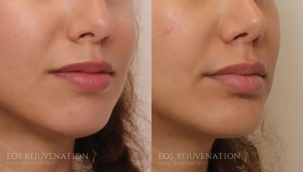 Chin Augmentation Before & After