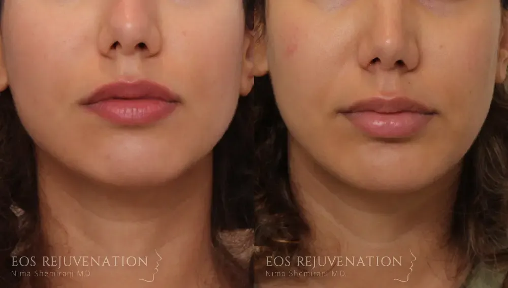 Chin Augmentation Before & After