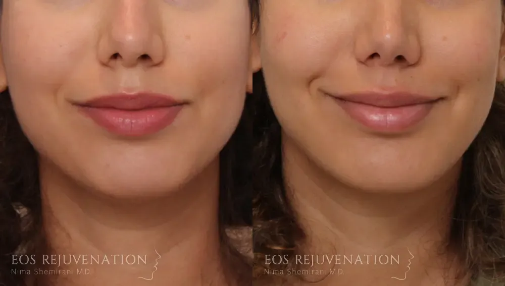 Chin Augmentation Before & After