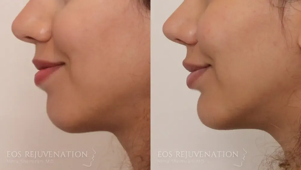 Chin Augmentation Before & After