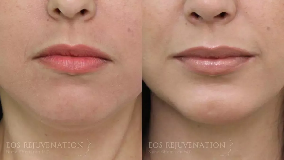 Chin Augmentation Before & After