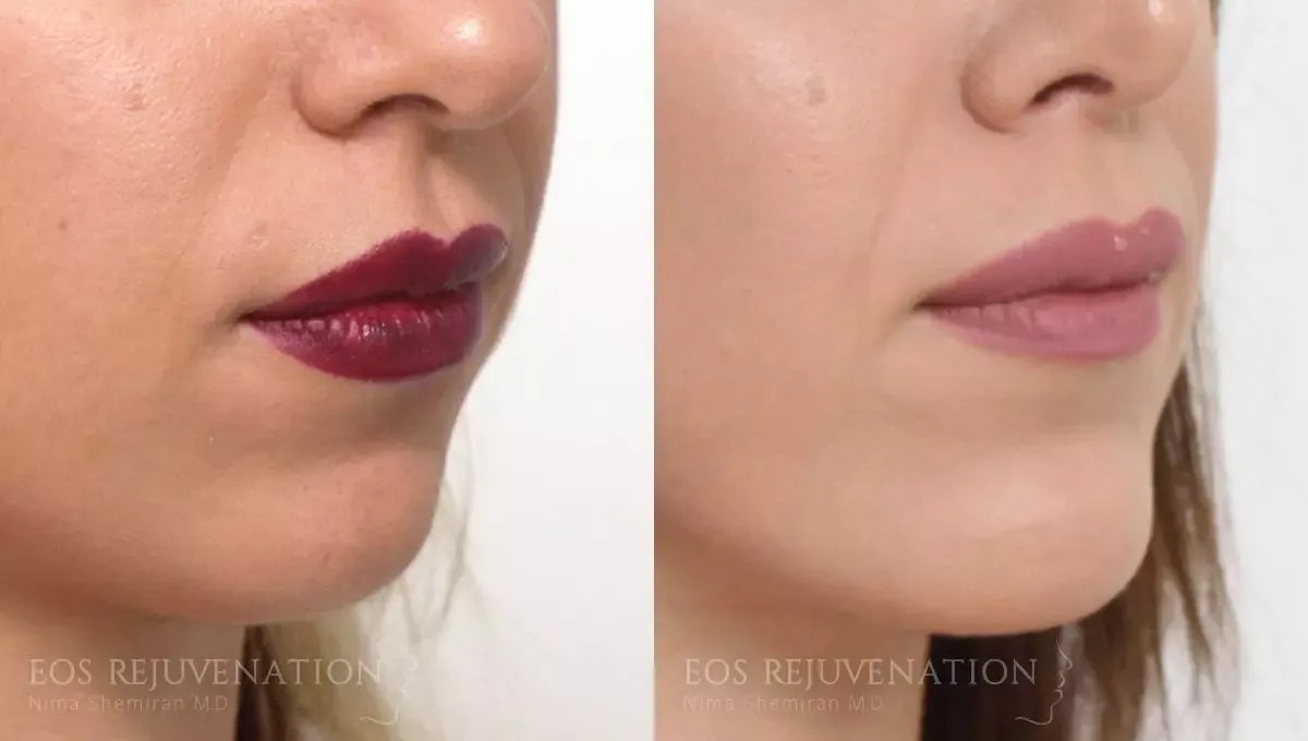 Chin Augmentation Before & After