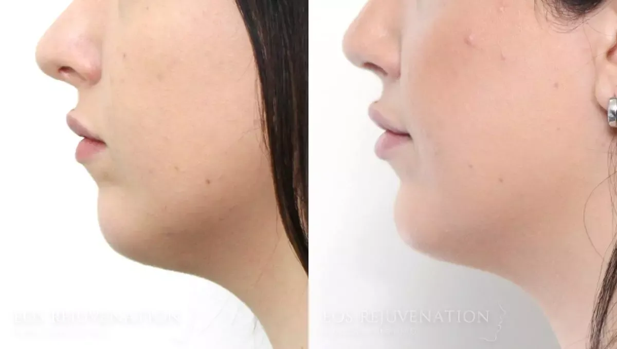 Chin Augmentation Before & After
