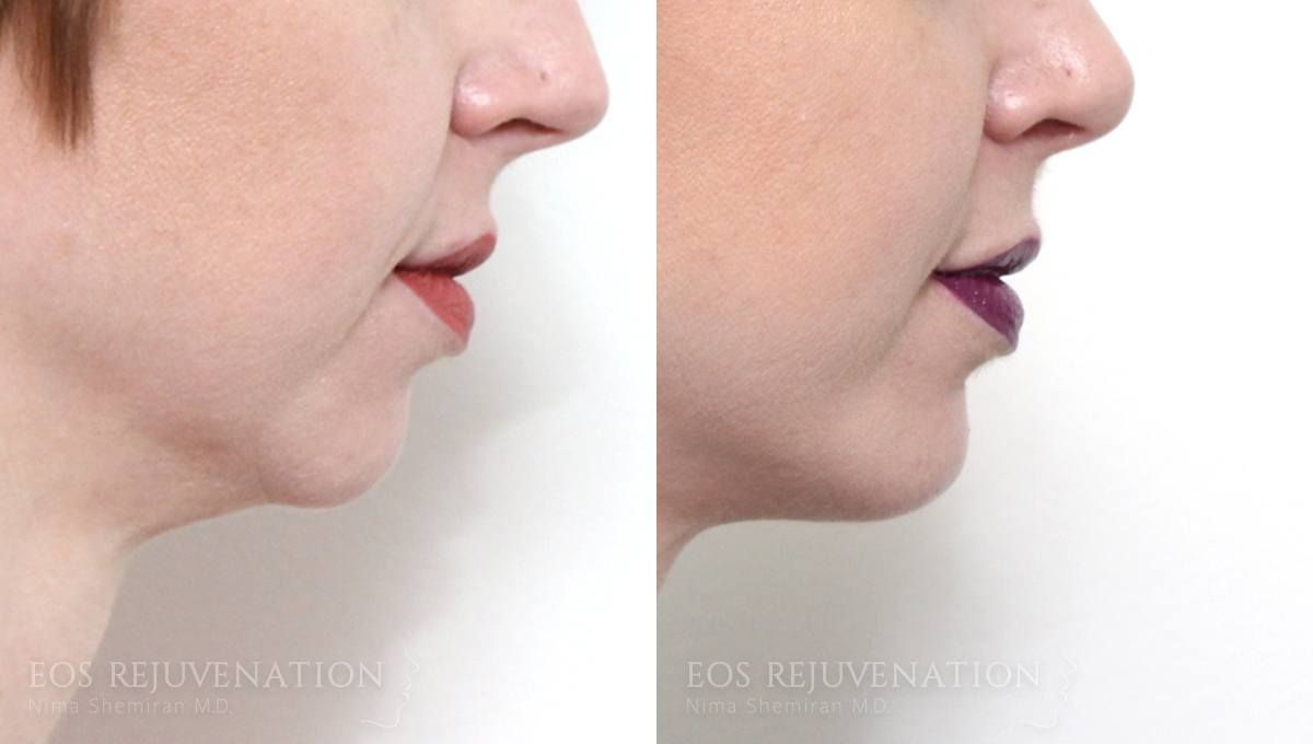 Chin Augmentation Before & After