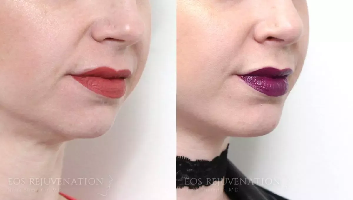 Chin Augmentation Before & After