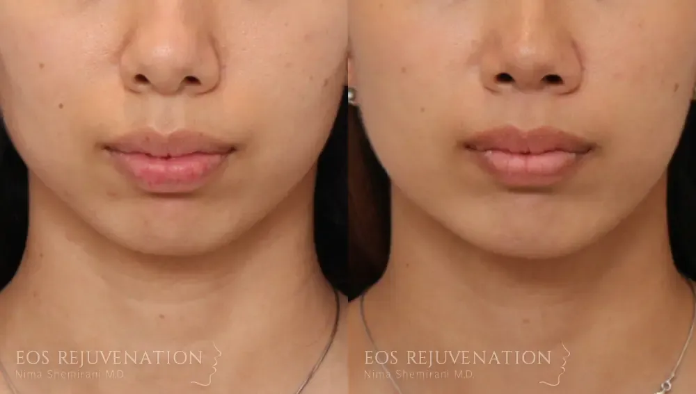 Chin Augmentation Before & After