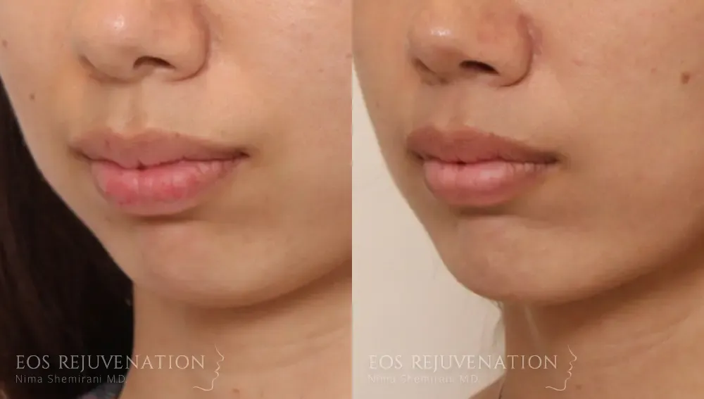 Chin Augmentation Before & After