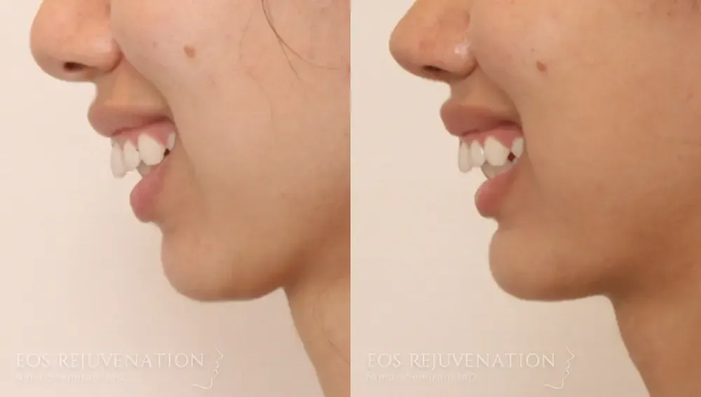 Chin Augmentation Before & After
