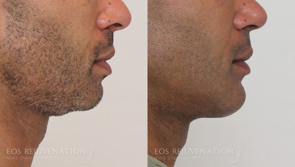 Chin Augmentation Before & After