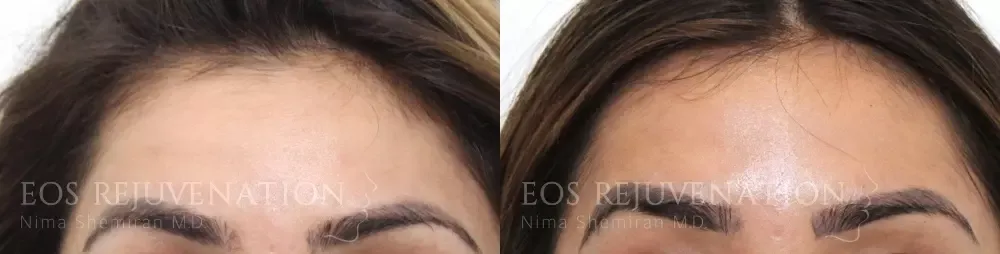 Botox Dysport Before & After