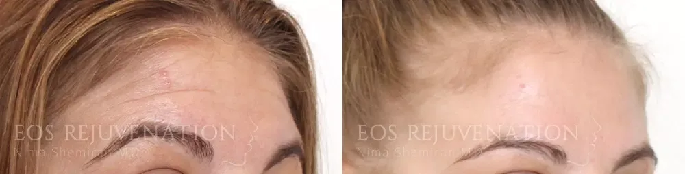 Botox Dysport Before & After