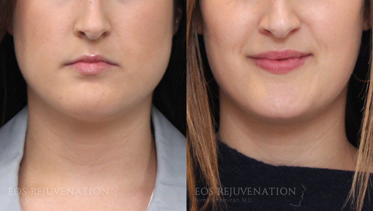Botox Dysport Before & After
