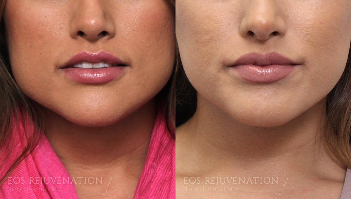 Botox Dysport Before & After