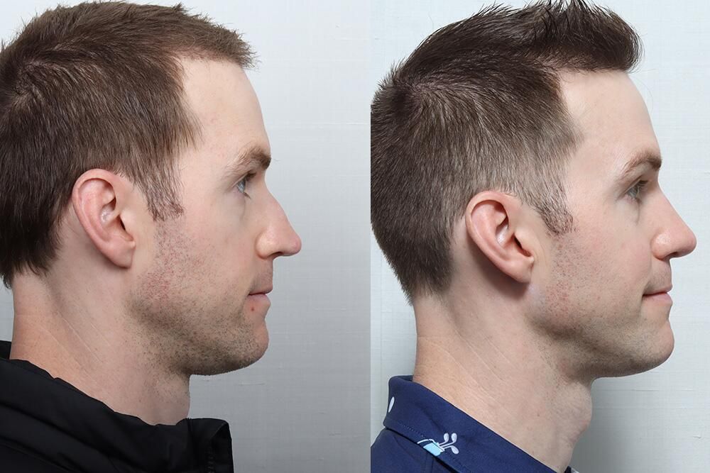 Male Rhinoplasty Before & After