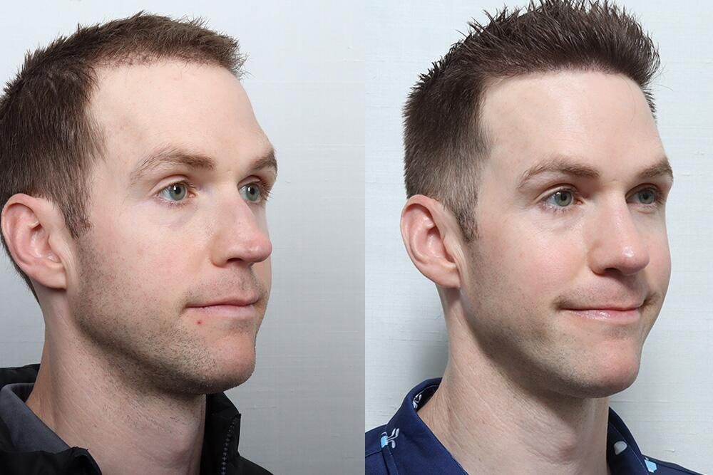 Male Rhinoplasty Before & After