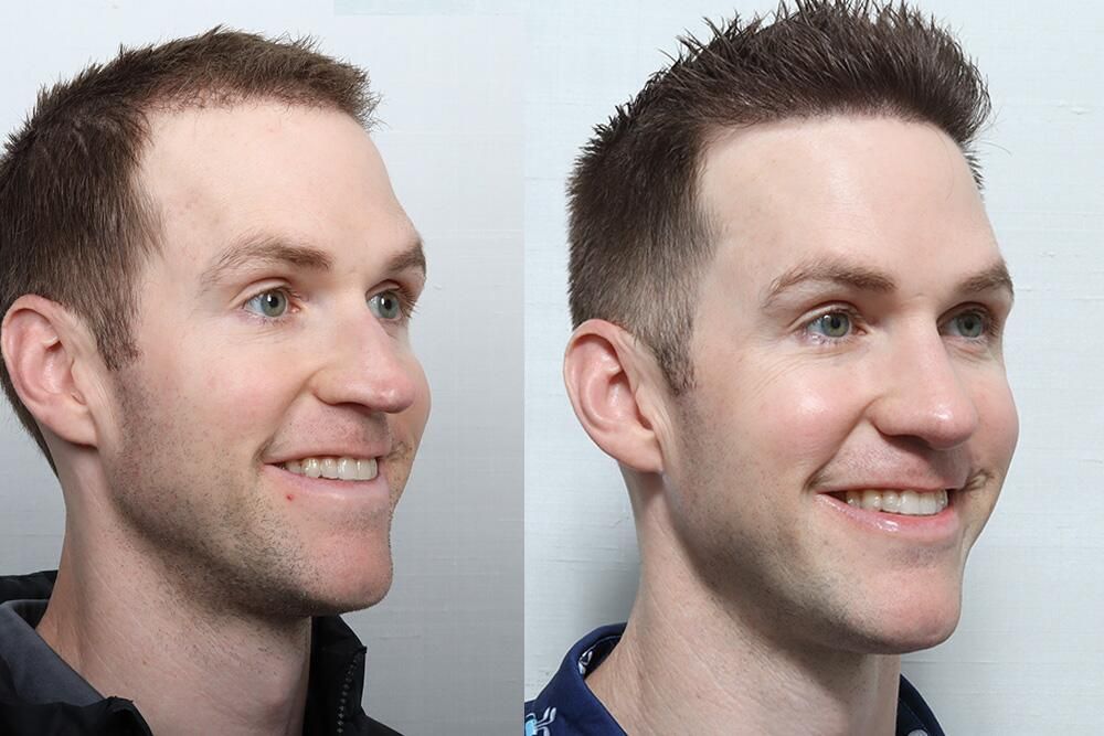 Male Rhinoplasty Before & After