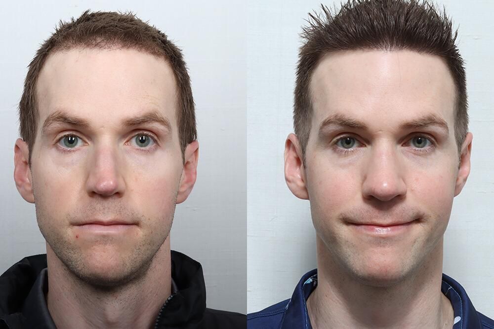 Male Rhinoplasty Before & After