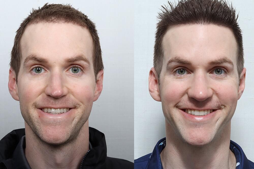 Male Rhinoplasty Before & After