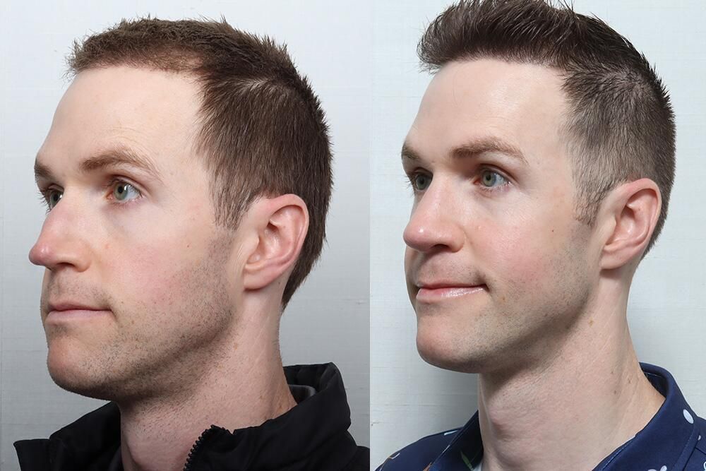 Male Rhinoplasty Before & After