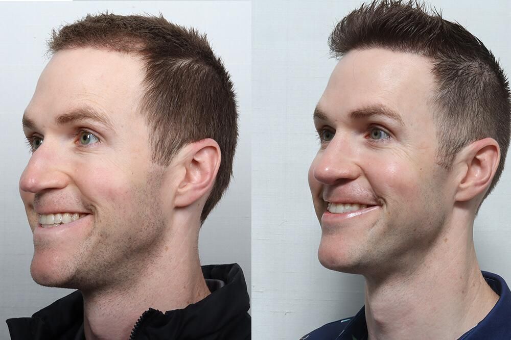Male Rhinoplasty Before & After