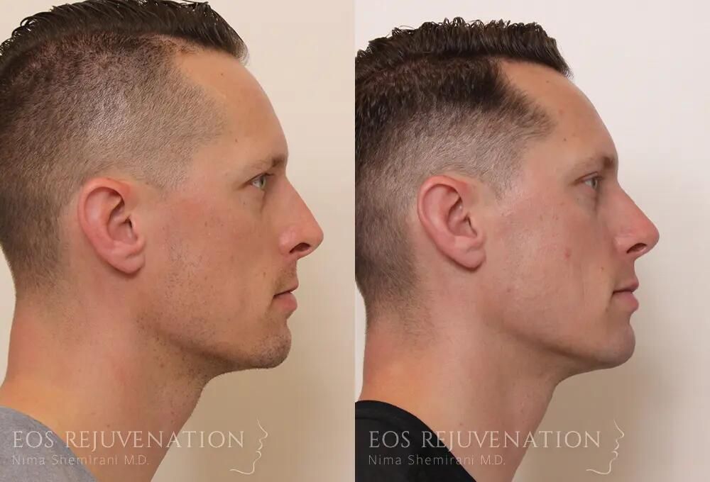 Male Rhinoplasty Before & After