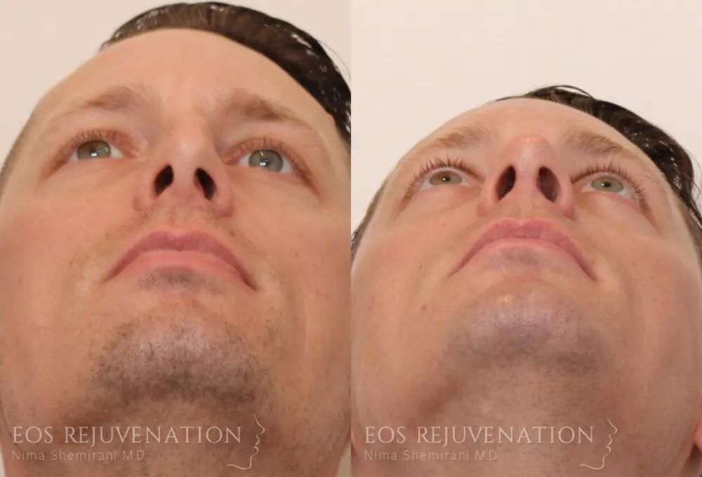 Male Rhinoplasty Before & After