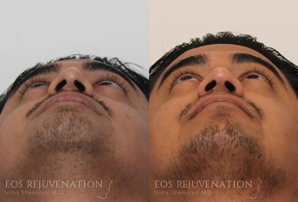Male Rhinoplasty Before & After