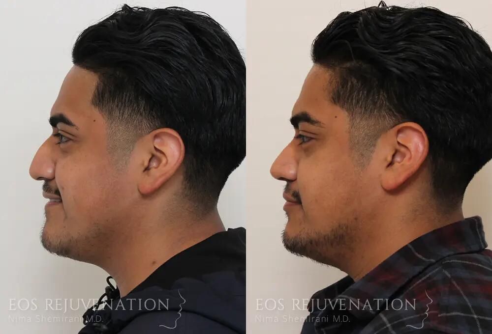 Male Rhinoplasty Before & After