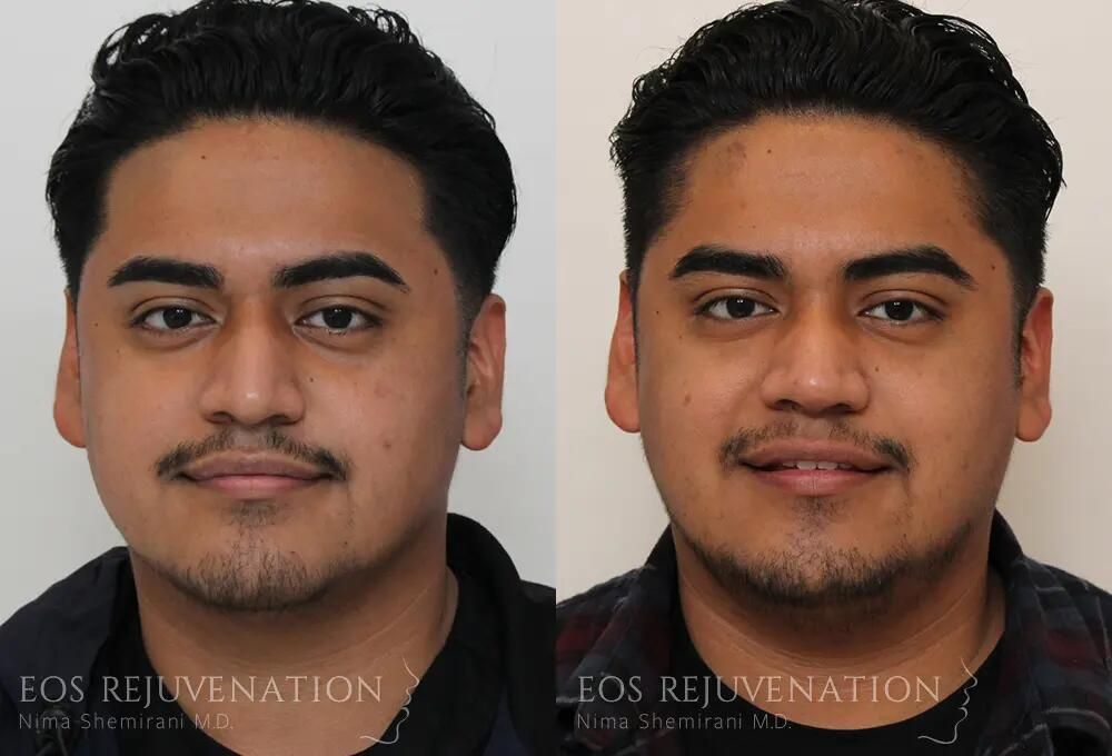 Male Rhinoplasty Before & After