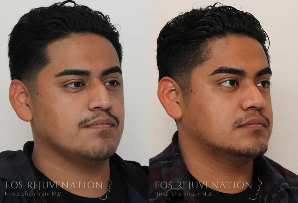 Male Rhinoplasty Before & After